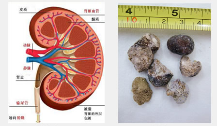 泌尿結石的治療